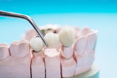 dental pliers placing a dental bridge