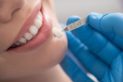 shade guide being used on a patient's smile