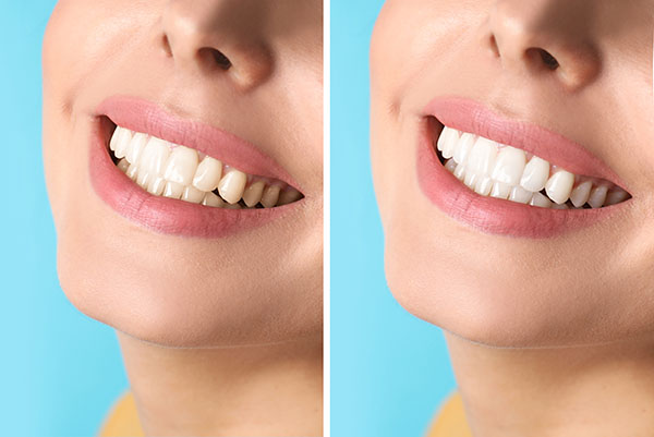 Cosmetic Dental Services With Natural Tooth Color from Integrity Family Dental in Denver, CO