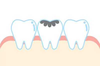 digital image of a dental filling