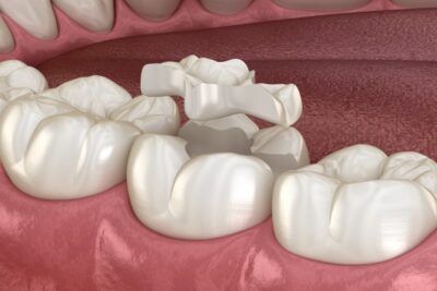 digital image of a dental inlay