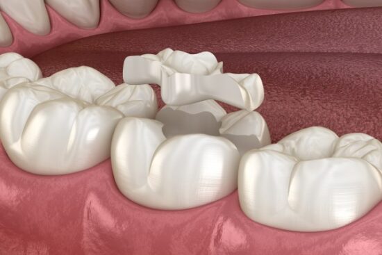 digital image of a dental inlay