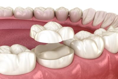 a digital image of a dental onlay