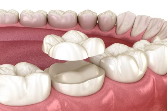 a digital image of a dental onlay