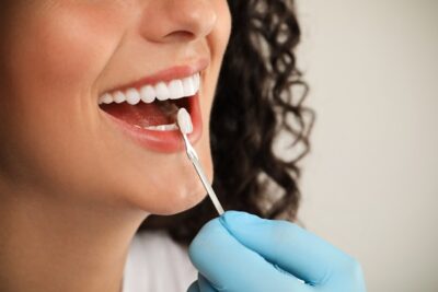 dentist using shade guide on a person's smile