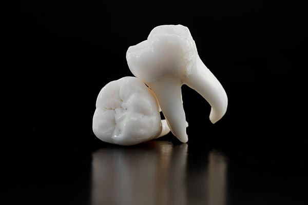 A General Dentist Talks Tooth Extractions from Integrity Family Dental in Denver, CO