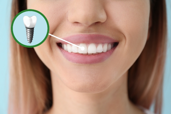 How Do I Know If I Need Dental Implants? from Integrity Family Dental in Denver, CO