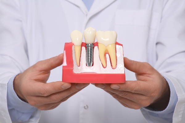 How Long Do Dental Implants Last? from Integrity Family Dental in Denver, CO