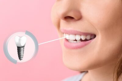 single dental implant and a person's smile