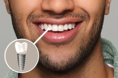 dental implant digital image and a man's mouth