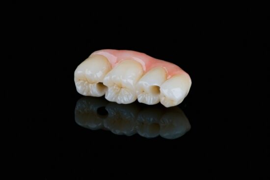 a single dental bridge