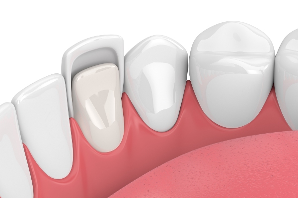 What Are the Different Types of Dental Veneers? from Integrity Family Dental in Denver, CO