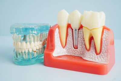 mouth molds with dental implants