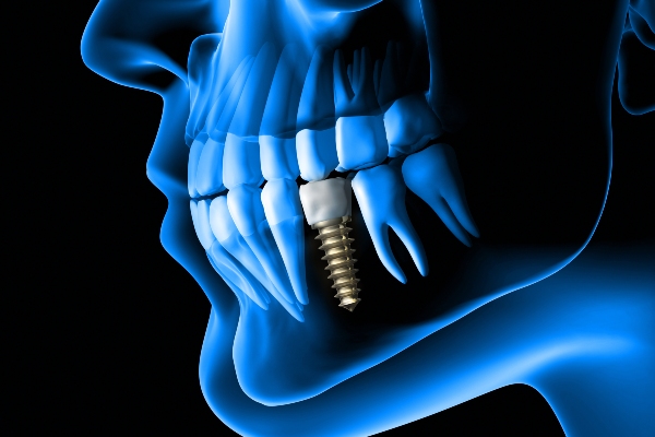 What to Expect During the Dental Implant Procedure from Integrity Family Dental in Denver, CO