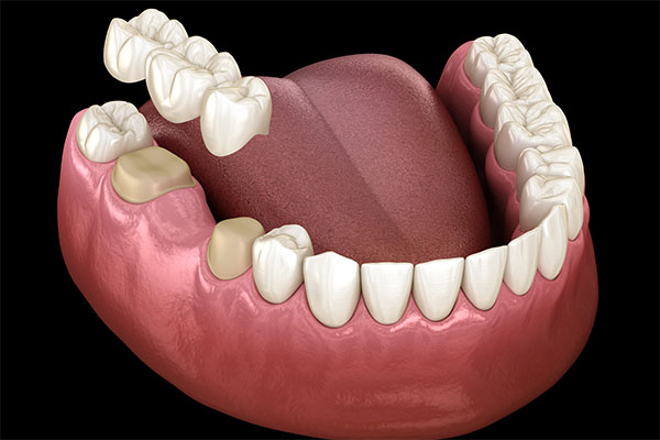 When a Dental Bridge Is a Cosmetic Dental Services Option from Integrity Family Dental in Denver, CO